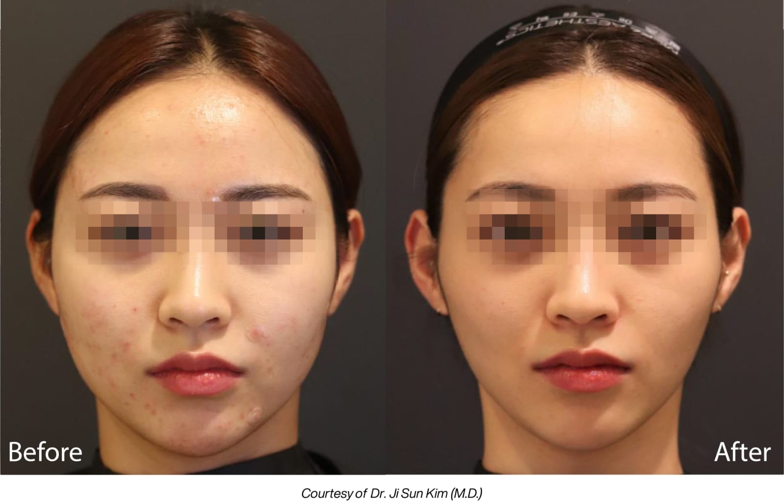 Hasil-treatment-LINEAR-Z.jpg