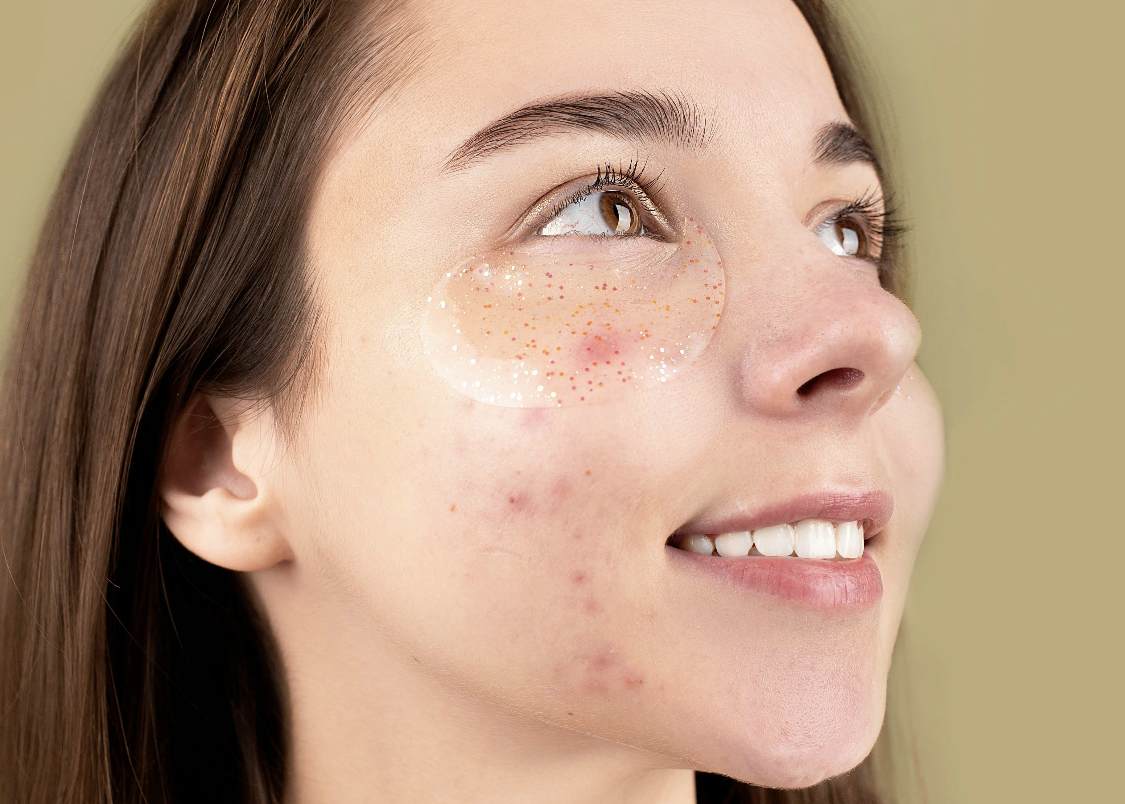 Acne-scars-concern.jpg