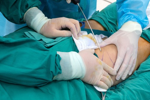 Liposuction.jpg