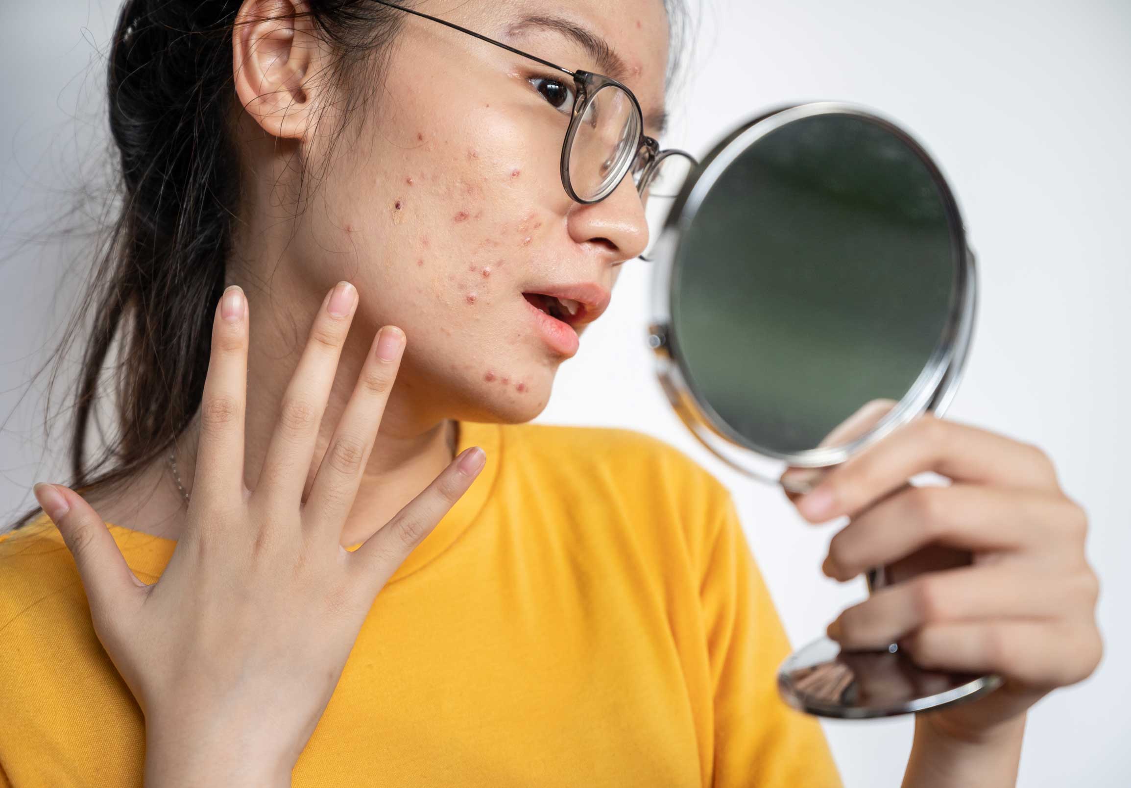 sunscreen-untuk-acne-prone-skin,jpg