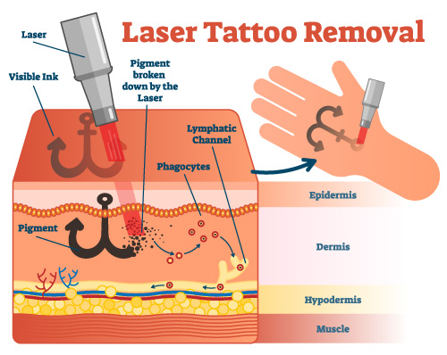 cara kerja laser tato